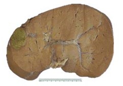 前列腺炎腹水晚期癥狀